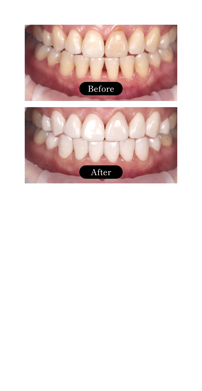 削らないラミネートベニア ブラックトライアングルの悩み
