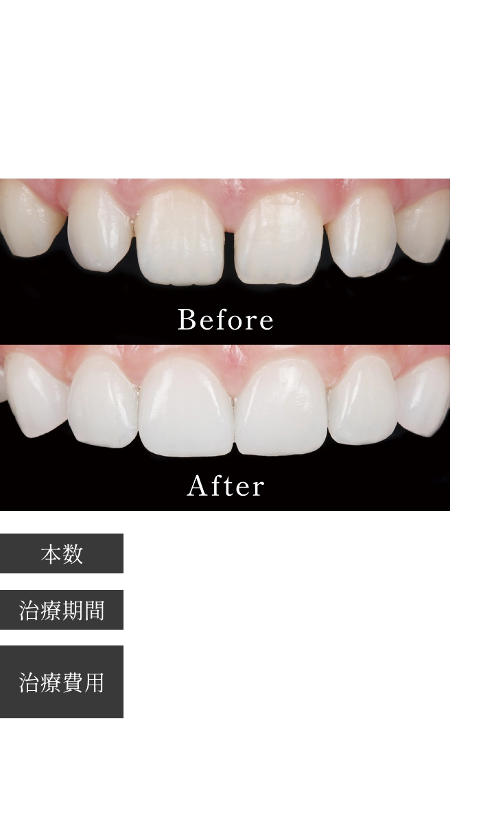 Case01 歯の隙間をなんとかしたい 安心して笑える歯にしたい