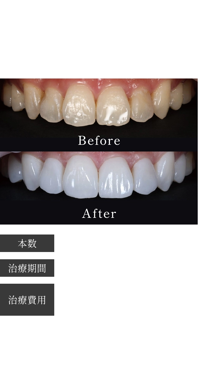 Case02 黄ばんでいる歯を綺麗な美しい白い歯に