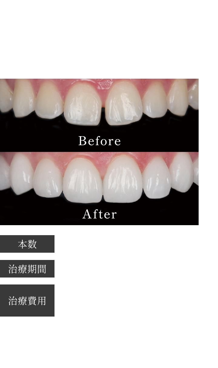 Case03 前歯の隙間をなんとかしたい 健康的な白い歯を手に入れたい