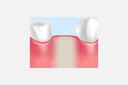 「抜歯即時埋入法」なら手術回数は1回で済みます