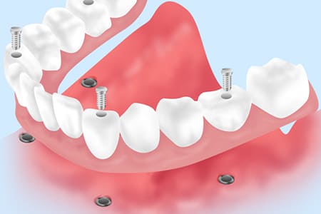 全ての歯を失った方でも「All-on-4」で負担のない治療を