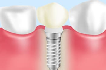 インプラント
