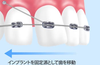 ミニインプラント矯正