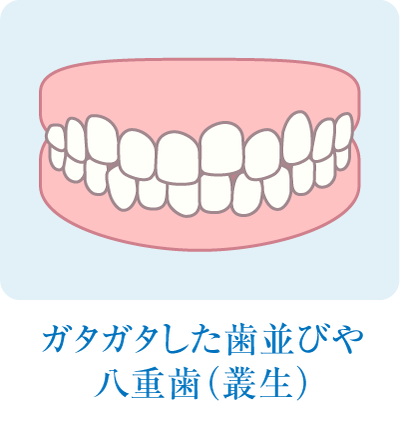 ガタガタした歯並びや八重歯（叢生）