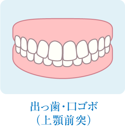出っ歯・口ゴボ（上顎前突）