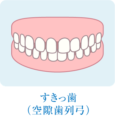 すきっ歯(空隙歯列弓)