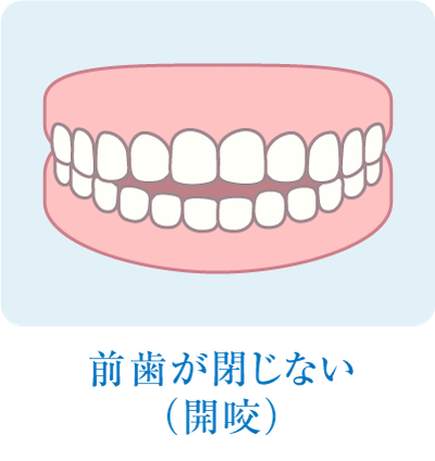 前歯が閉じない(開咬)