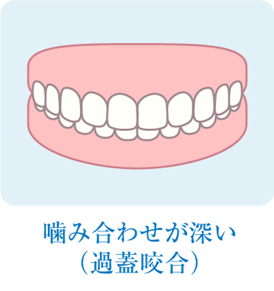 噛み合わせが深い(過蓋咬合)