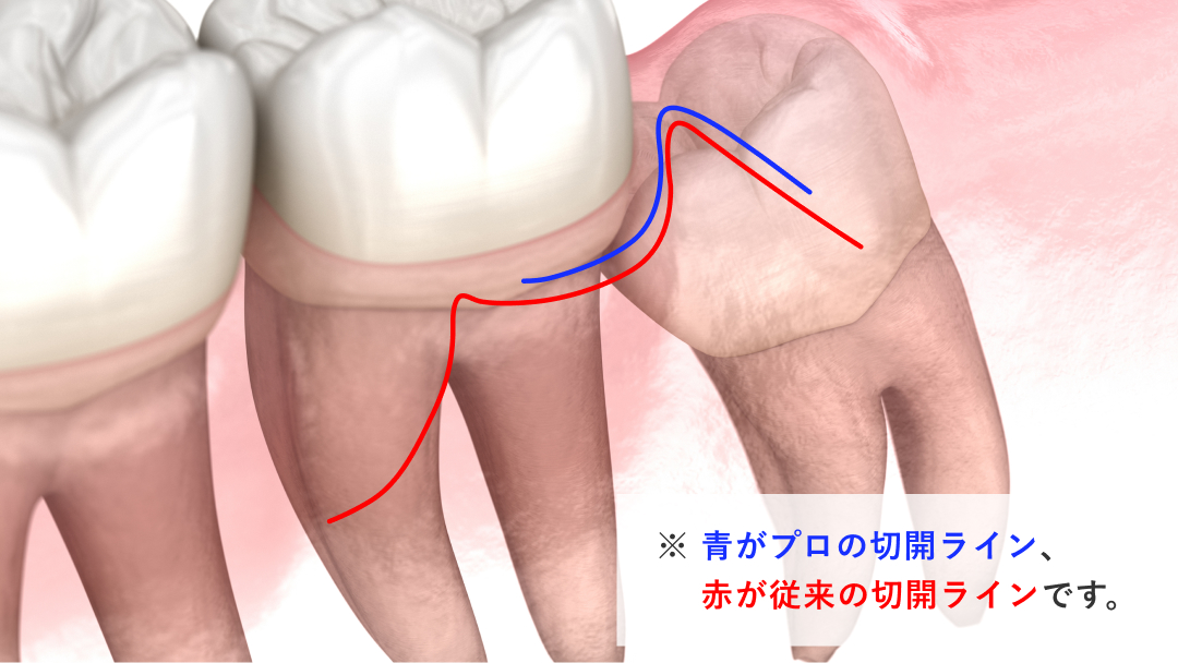 プロと従来の切開ラインの差