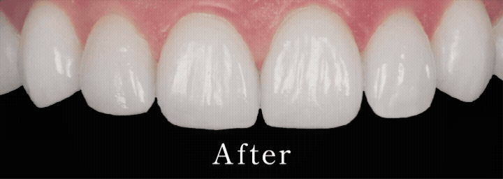 あと少しを一瞬で削らずに叶える理想の歯 韓国で大人気の削らないラミネートベニア